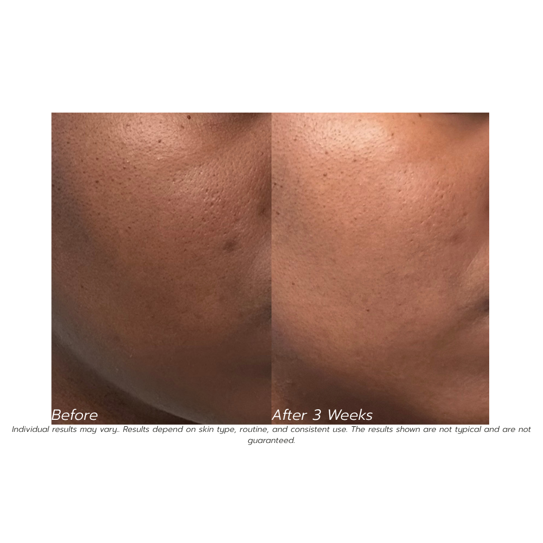 Before and after comparison of skin texture on a person's face, showing results after 3 weeks.